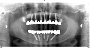 Radiographie panoramique