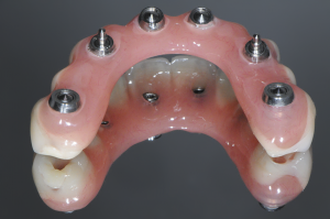 Prothèse provisoire