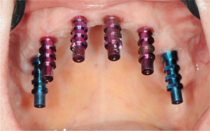 Diamètre de plateau