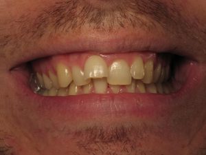 sourire VOCO 3D photos 2D.001