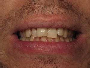 sourire VOCO 3D photos 2D.004