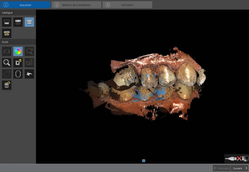 Empreinte optique avant affinage (Carestream CS3500)