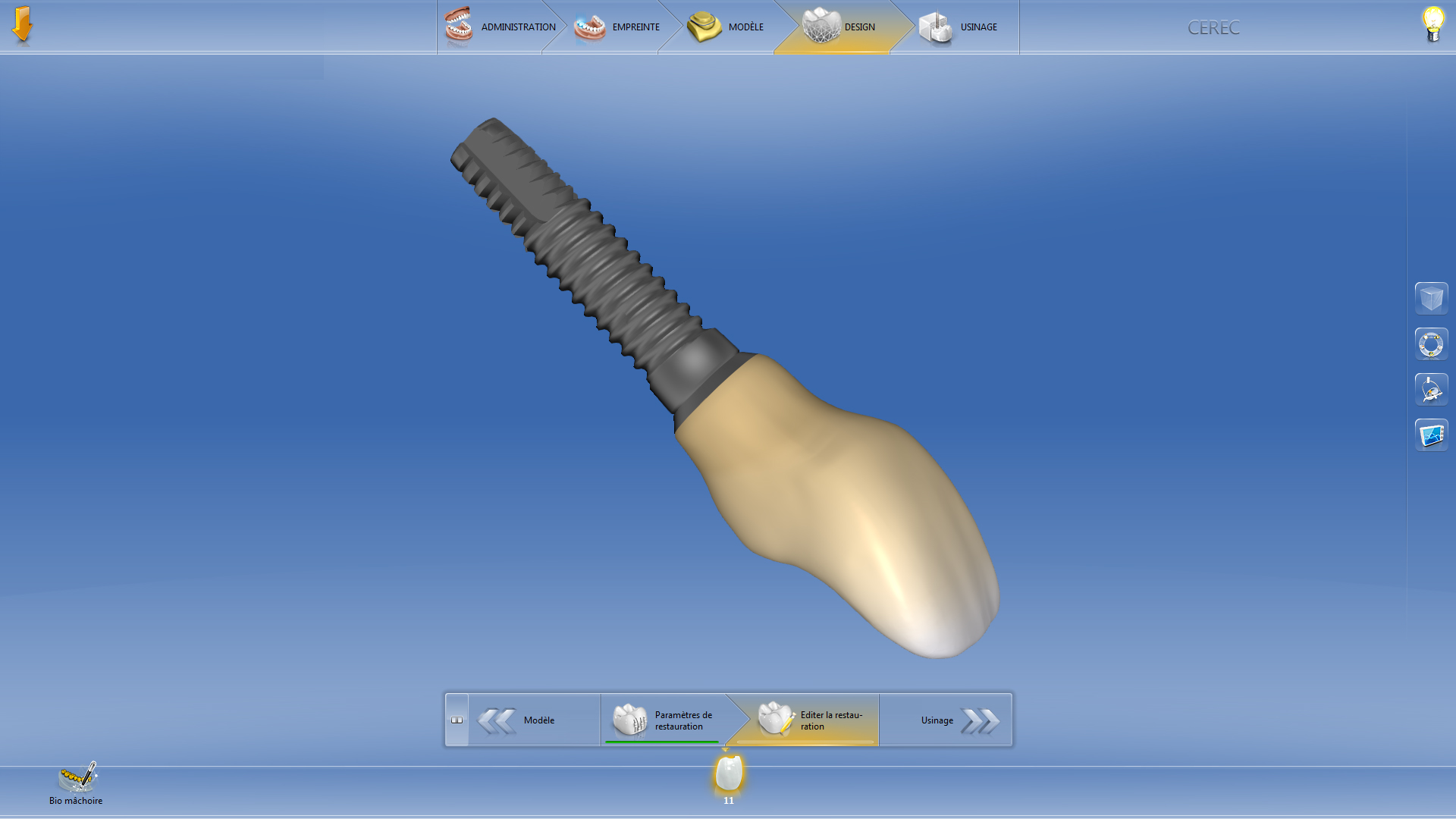11. Optimisation du profil d'émergence d'une couronne provisoire en site de 11