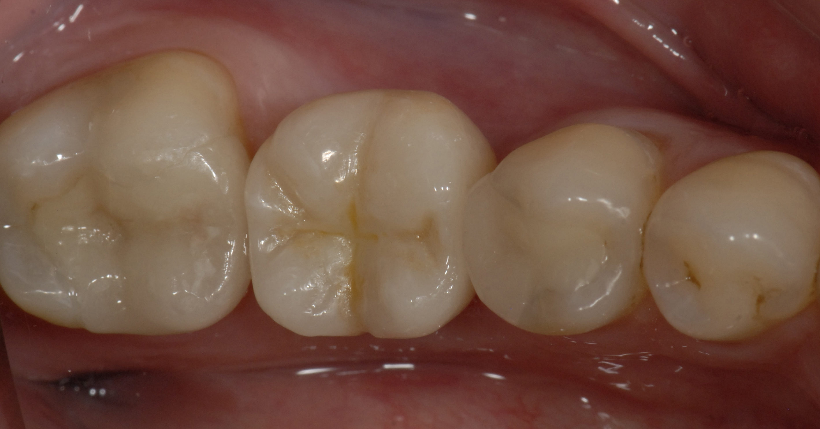 14c. Résultat final vue occlusale