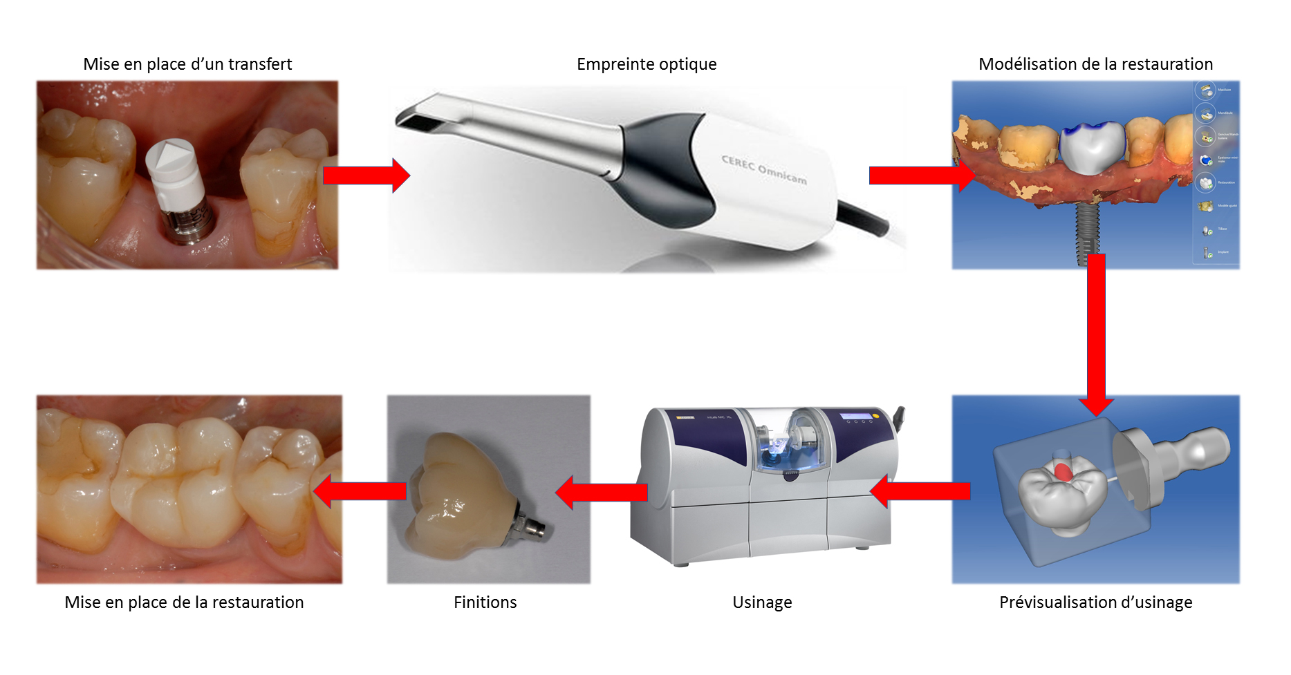 1b. La chaîne numérique en IAO. Prothèse implanto portée
