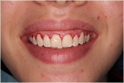 Fig. 2 : élongation coronaire