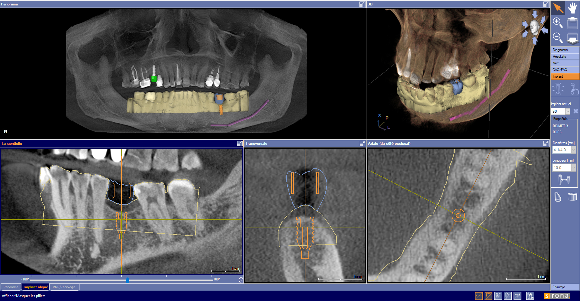 5. Planification implantaire guidée par la forme de la future couronne