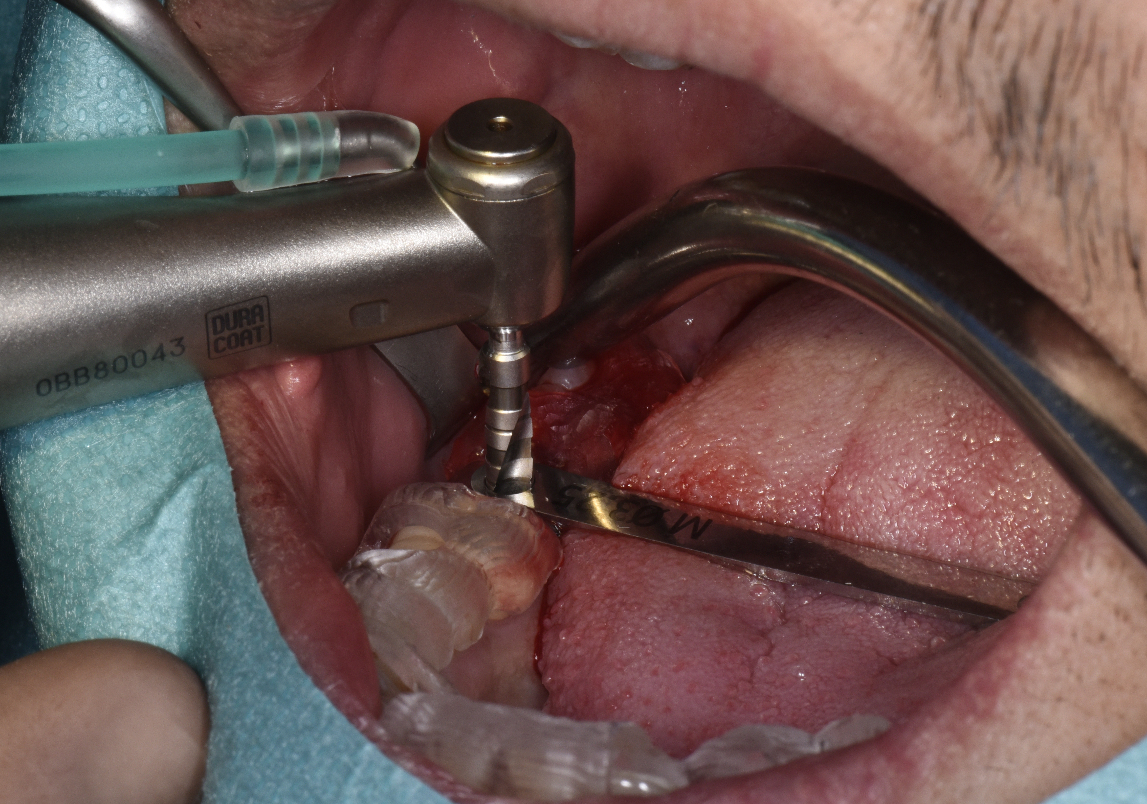 8. Itilisation du guide chirurgical et des douilles de guidage