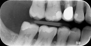 Radio pré-opératoire restauration deuxième prémolaire