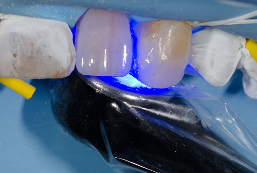 Une polymérisation de 60 secondes par face est réalisée