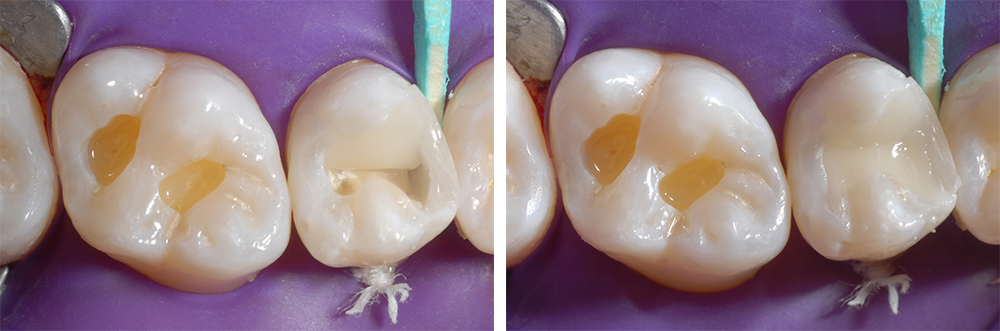 Ill. 11 et 12 : Modelage de la surface occlusale avec une couche sur la cuspide palatine, suivie d'une couche sur la cuspide vestibulaire