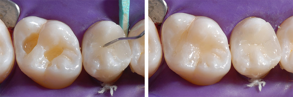 Ill. 13 : Modelage du sillon central avec une sonde fine avant le durcissement des couches occlusales Ill. 14 : Obturation des cavités au niveau de la dent 16 avec une seule couche par cavité