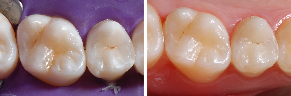Ill. 15 : Caractérisation des sillons avec une teinte de composite marron Ill. 16 : Harmonie d'esthétique et de fonctionnalité des restaurations achevées