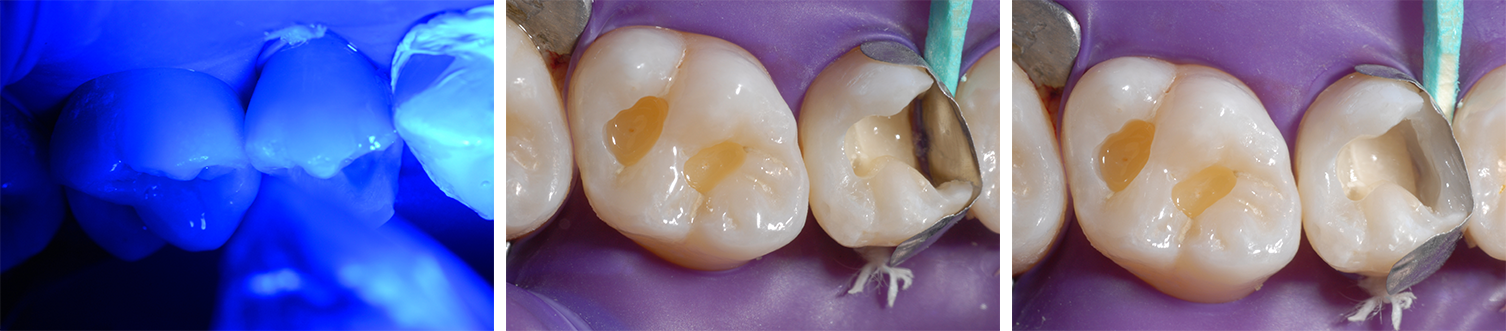 Ill. 8 : Photopolymérisation de la couche d'adhésif pendant 10 secondes Ill. 9 : Matrice fixée Ill. 10 : Reconstitution de la paroi mésiale de la dent 15 avec une seule couche d'Admira Fusion x-tra