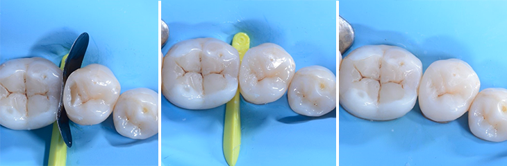 Restauration de classe II de la deuxième prémolaire