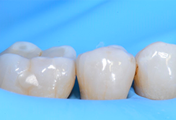 Restauration de classe II de la deuxième prémolaire