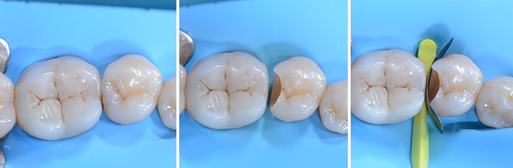 Restauration de classe II de la deuxième prémolaire