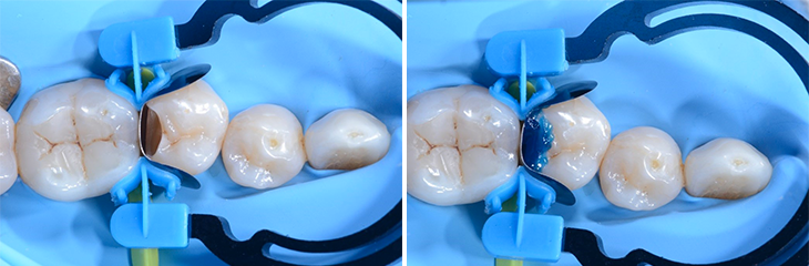 Restauration de classe II de la deuxième prémolaire
