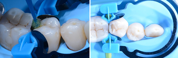 Restauration de classe II de la deuxième prémolaire