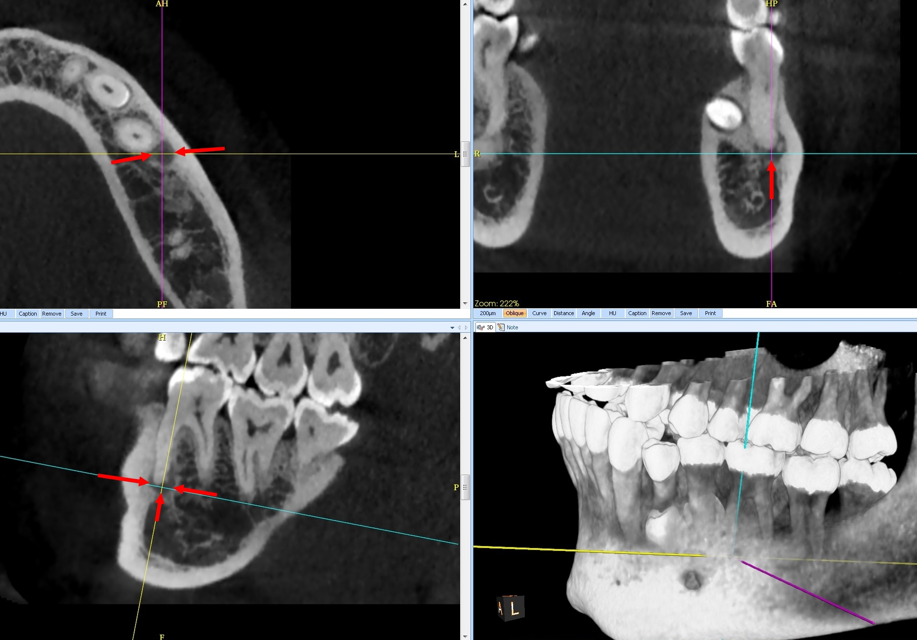 Fig.1 : Dysplasie cémento-osseuse au stade I. Découverte radiologique fortuite par CBCT : lacune apicale sur dent vivante. L’évolution par calcification centrifuge confirme le diagnostic.