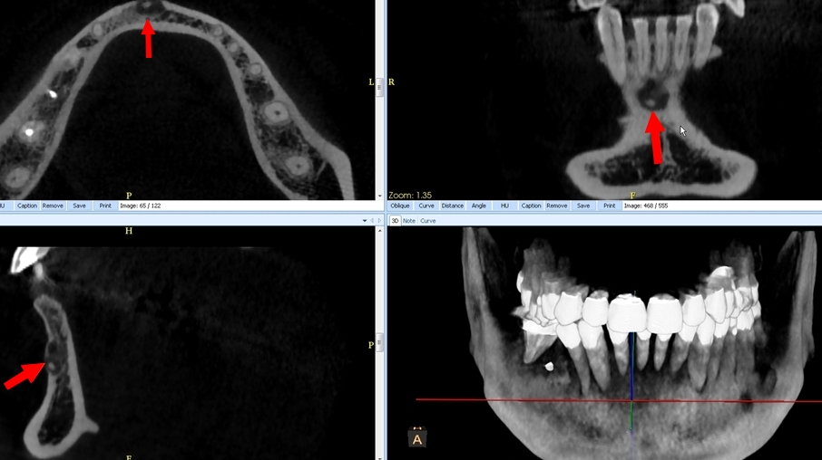 Fig.2 : Dysplasie cémento osseuse (DCO) apicale, stade II: Découverte fortuite par CBCT: lacune apicale en cocarde, avec condensation centrale.