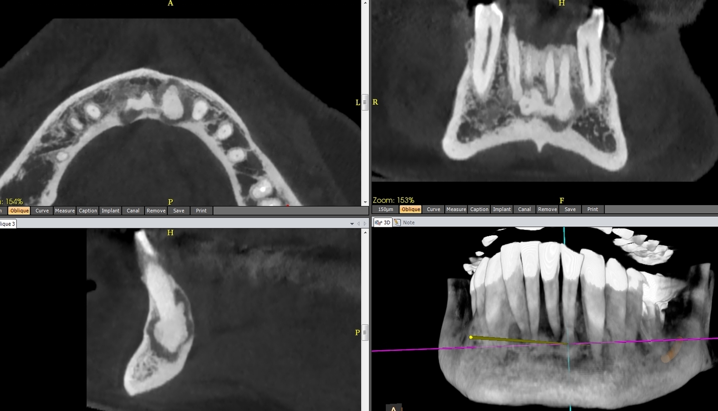Fig.3 : Dysplasie cémento osseuse (DCO) apicale, stade III: Découverte fortuite par CBCT: hyperdensités apicales cernées par liseré clair périphérique des 4 incisives.