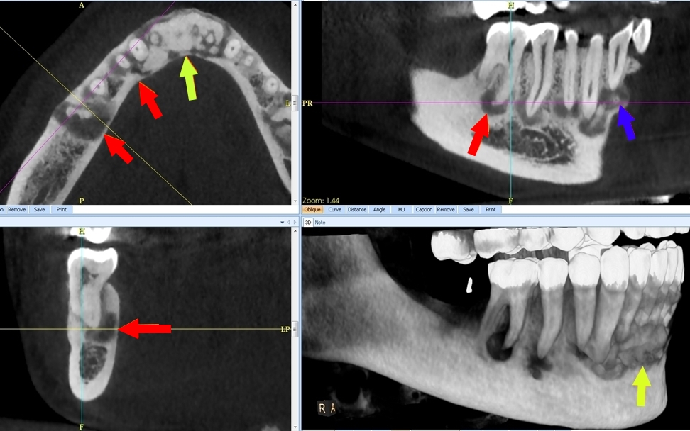 Fig.4 DYSPLASIE OSSEUSE FLORIDE TOUS LES STADES