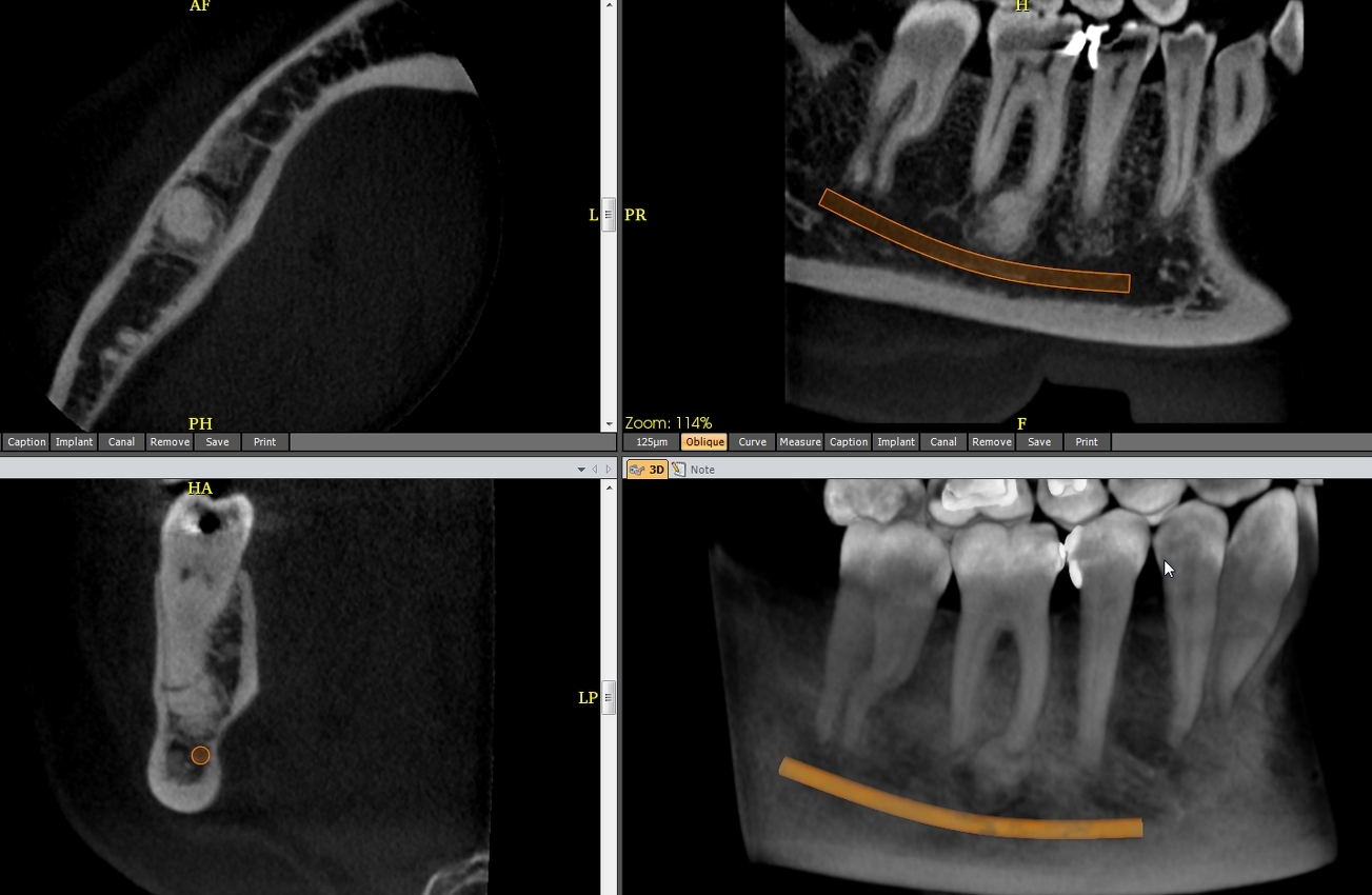 Fig.5. Cémentoblastome ou cémentome. Formation dense bien limitée, adhérant à l’apex de 46, asymptomatique. Difficile à distinguer d’une dysplasie osseuse focale au stade 3.