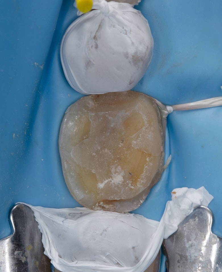 Téflon pour isoler les dents adjacentes