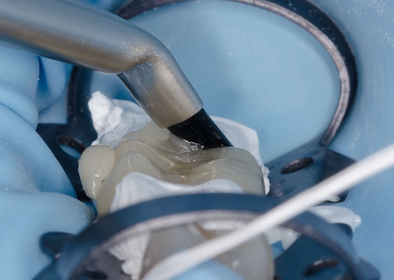 Pinceau imbibé de composite primer pour le retrait des excès.