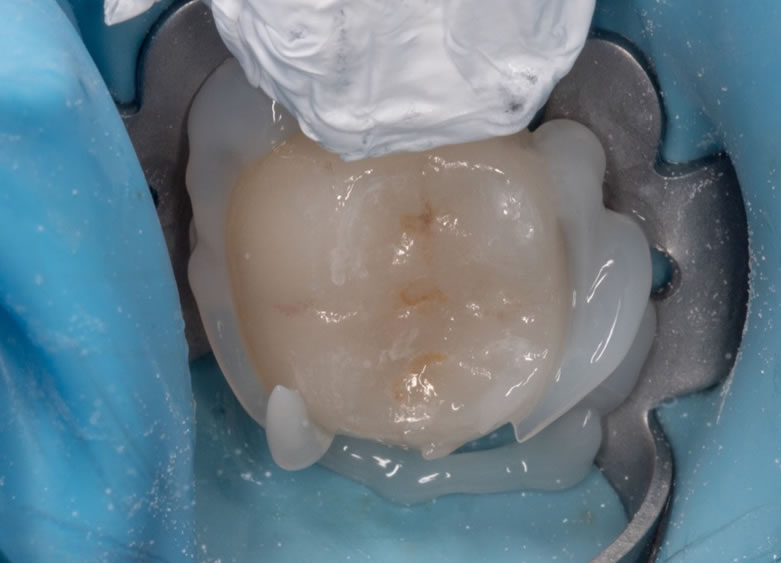 Try-in translucide pour polymérisation finale.