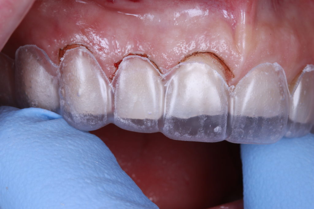 Résultat esthétique d’un traitement dentaire complexe