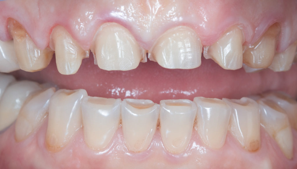 Résultat esthétique d’un traitement dentaire complexe