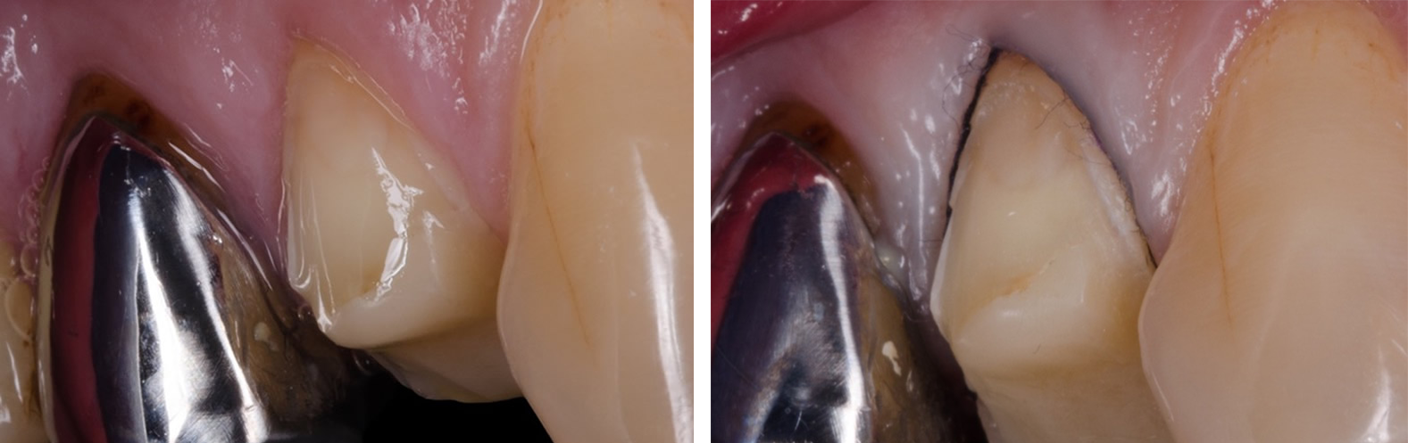 Préparation avant et après mise en place du cordonnet