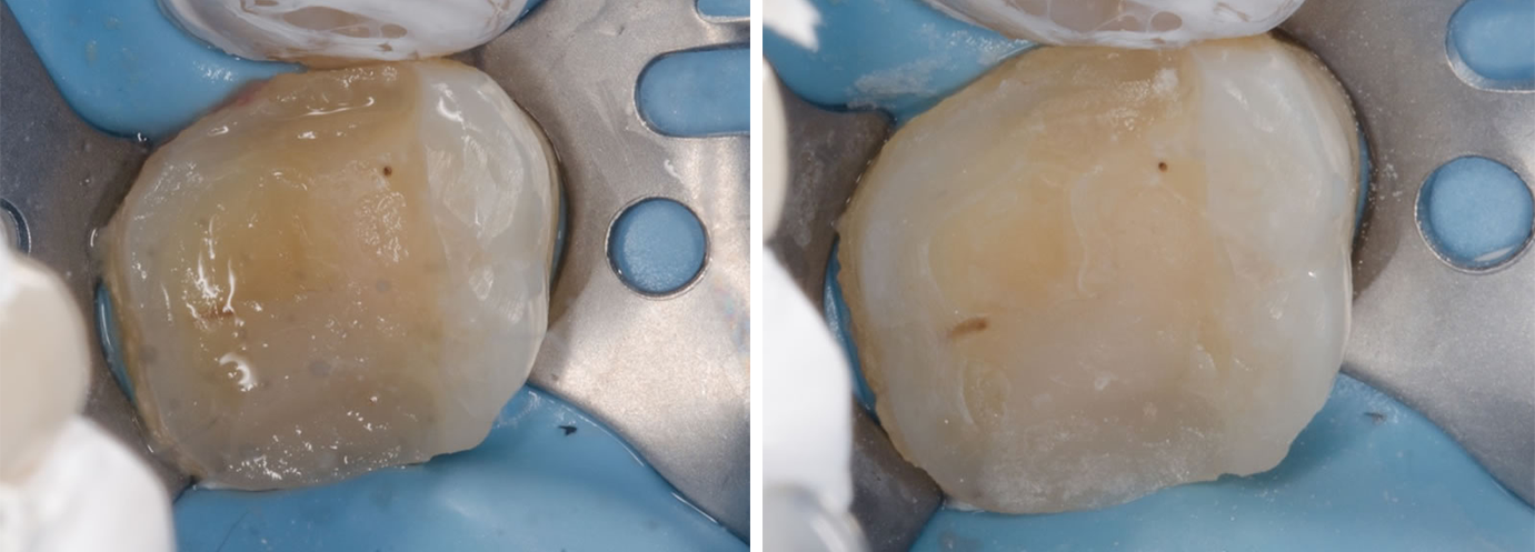 Dent préparée avant microsablage Dent préparée après microsablage