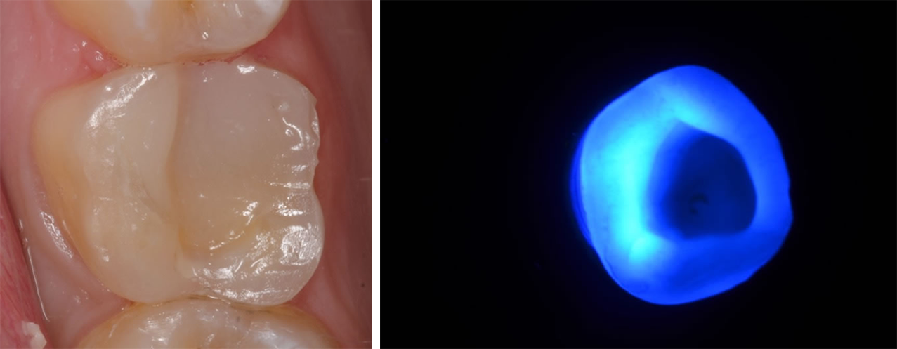 Obturation de la base dentaire avec un composite de restauration, la même teinte sera utilisée lors de la séance de collage Passage de la lumière dans une endocouronne. La composite au niveau de la chambre sera difficile à photopolymeriser