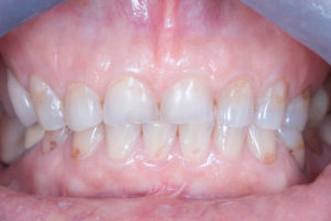 Résultat esthétique d’un traitement dentaire complexe