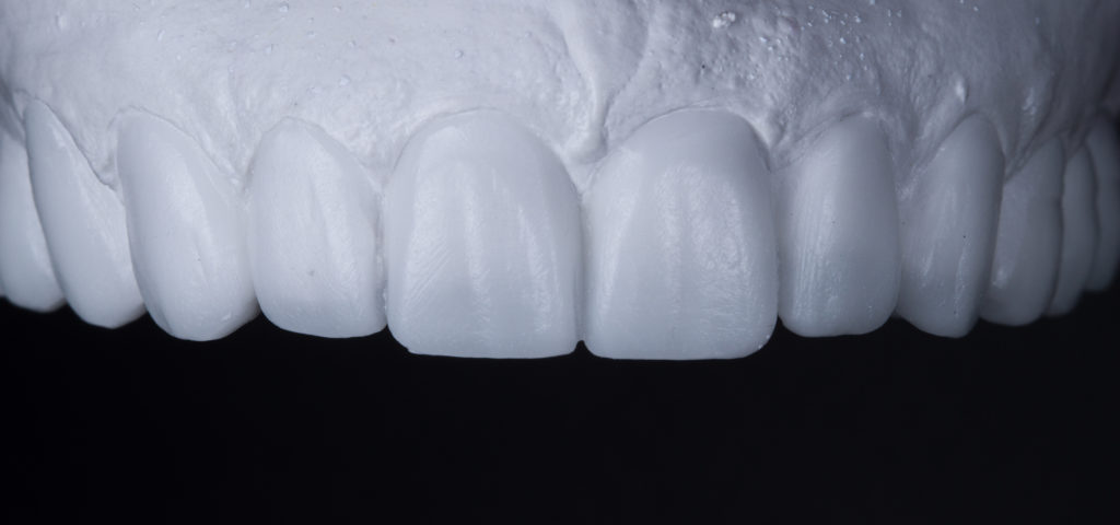 Résultat esthétique d’un traitement dentaire complexe