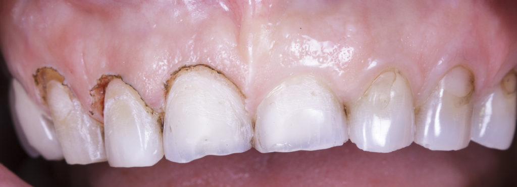 Résultat esthétique d’un traitement dentaire complexe