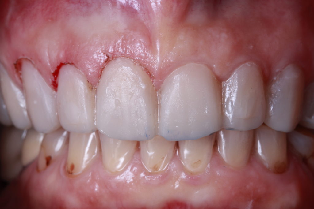 Résultat esthétique d’un traitement dentaire complexe