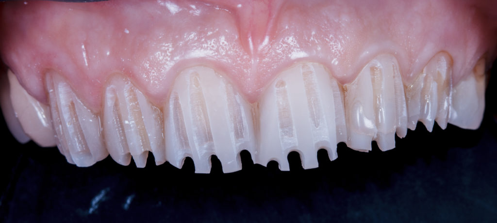 Résultat esthétique d’un traitement dentaire complexe