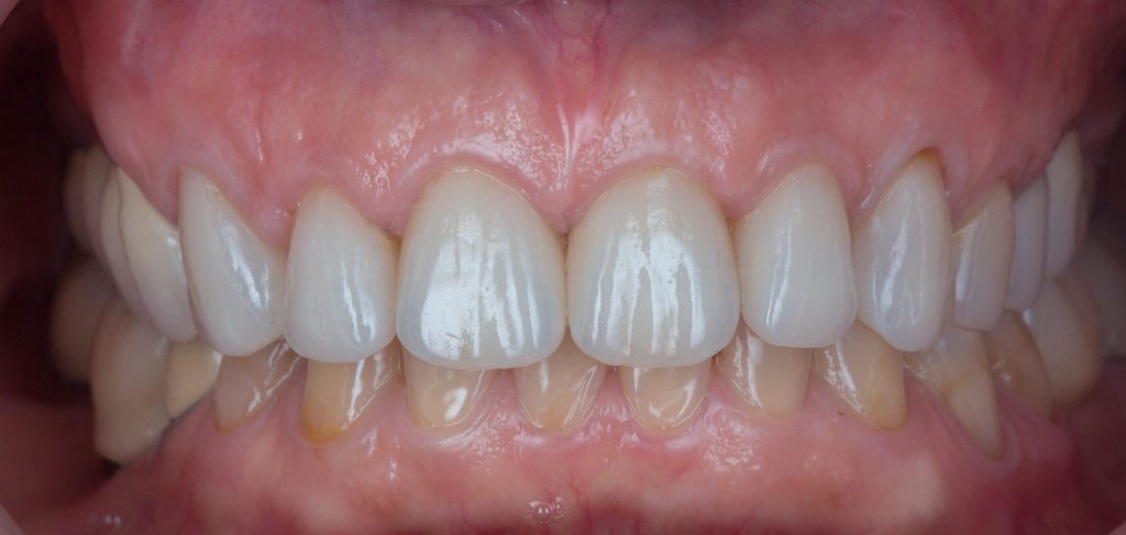Résultat esthétique d’un traitement dentaire complexe