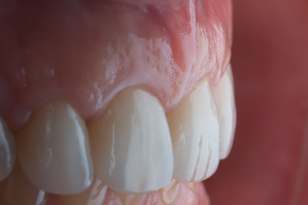 Résultat esthétique d’un traitement dentaire complexe