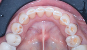 Résultat esthétique d’un traitement dentaire complexe