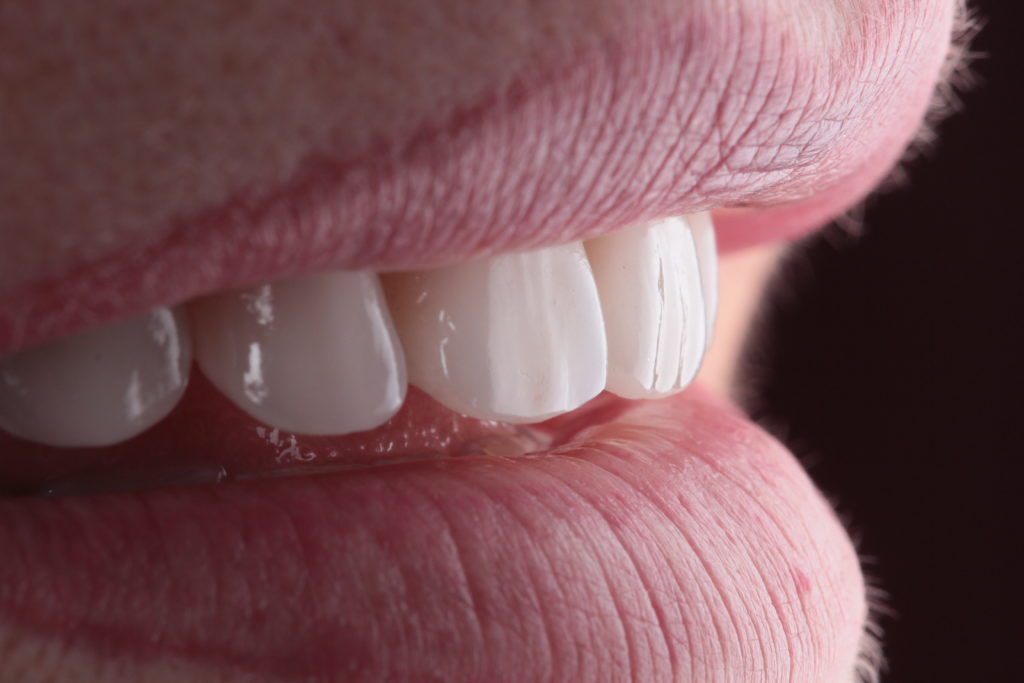 Résultat esthétique d’un traitement dentaire complexe