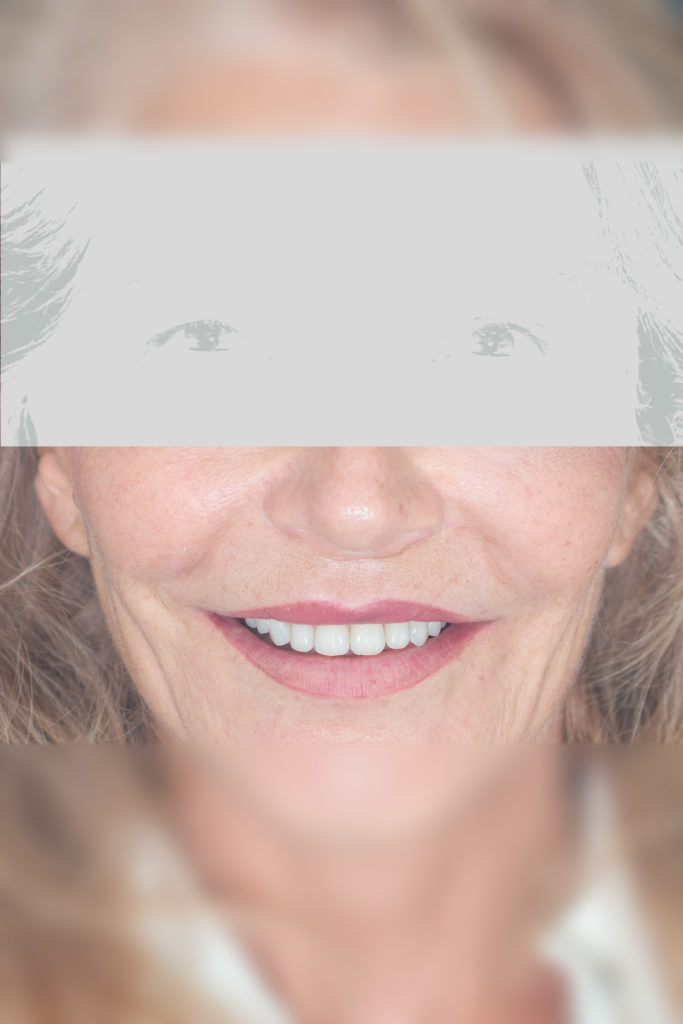 Résultat esthétique d’un traitement dentaire complexe