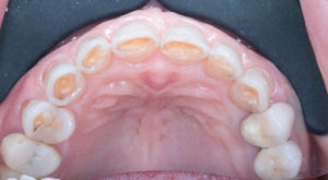 Résultat esthétique d’un traitement dentaire complexe