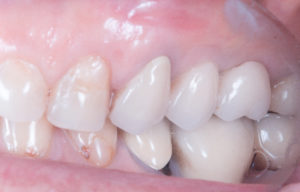 Résultat esthétique d’un traitement dentaire complexe