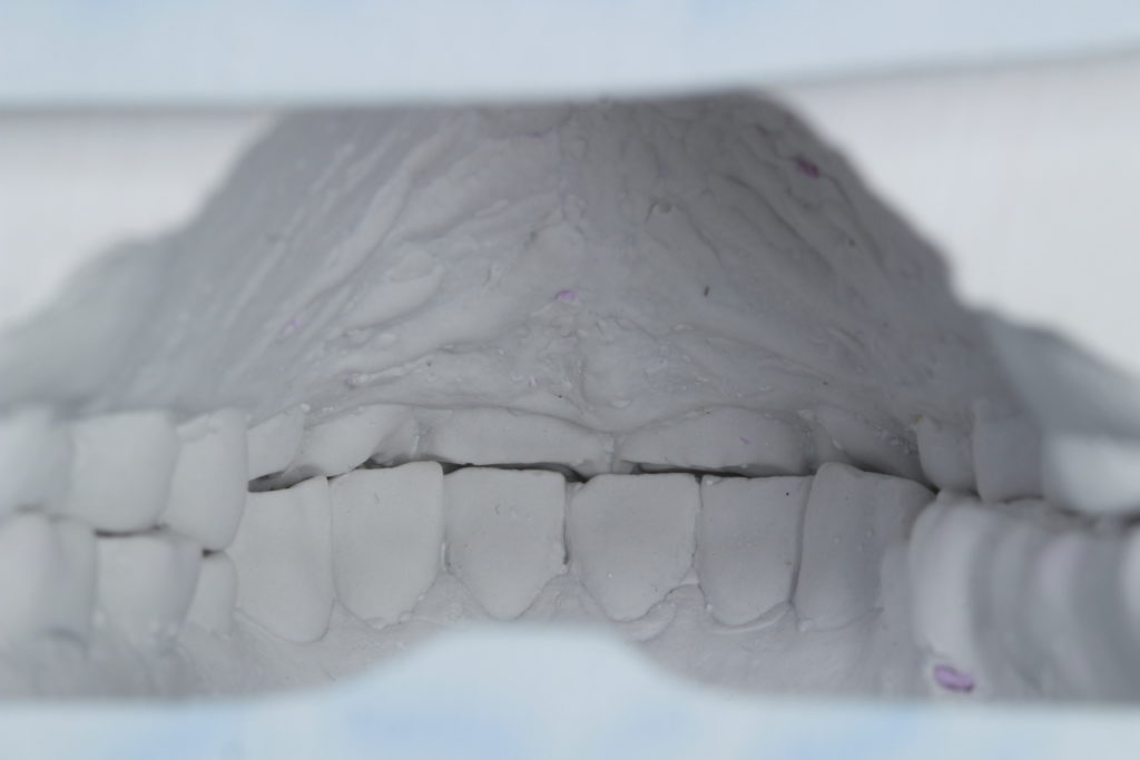Résultat esthétique d’un traitement dentaire complexe