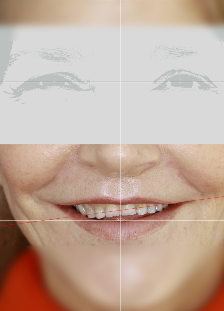 Résultat esthétique d’un traitement dentaire complexe